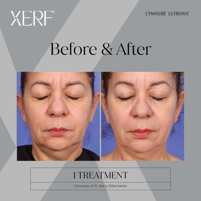 XERF BEFORE AND AFTER IMAGES BY CYNOSURE