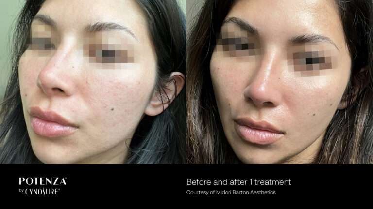Before and After Potenza Treatment