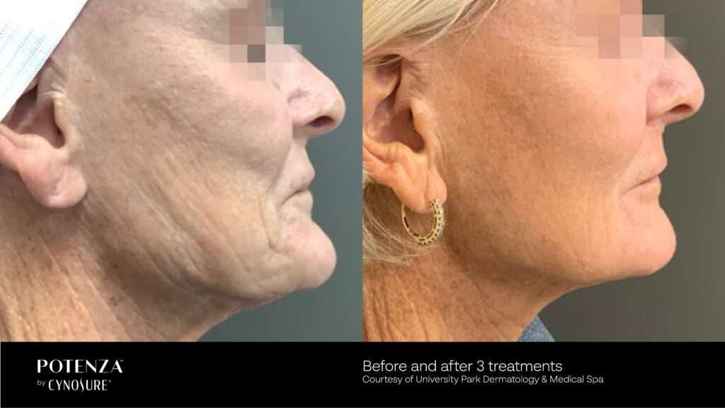 Before and After Photos Potenza RF Microneedling