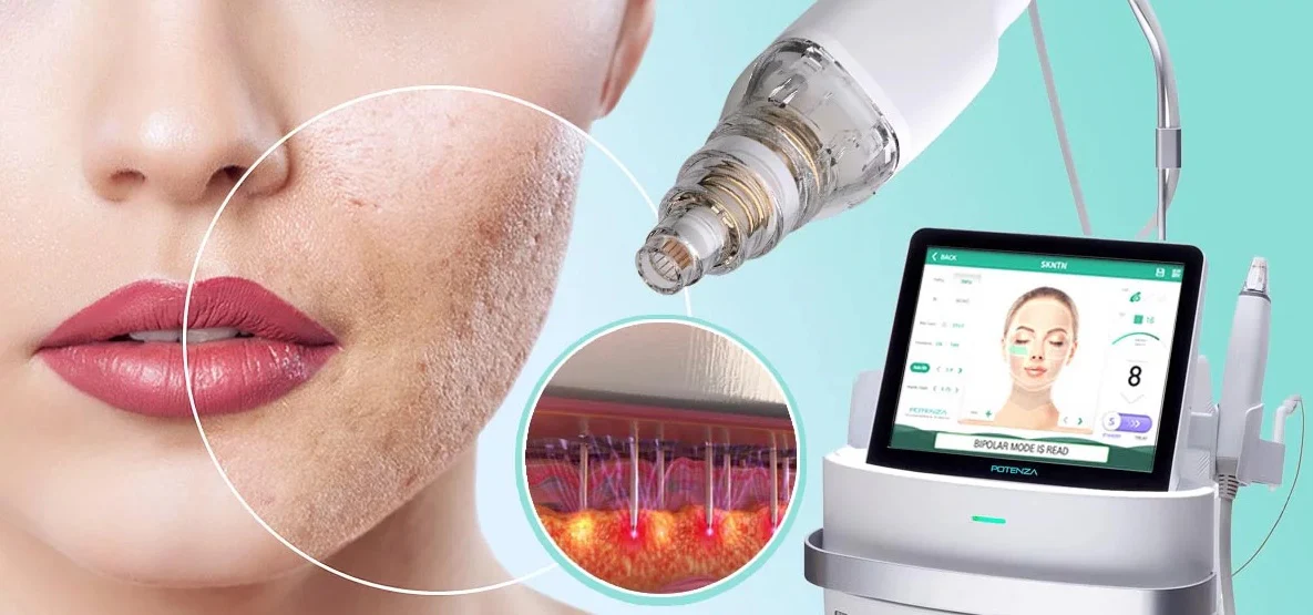 Potenza RF Microneedling