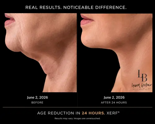 XERF skin tightening image of before and after XERF treatment