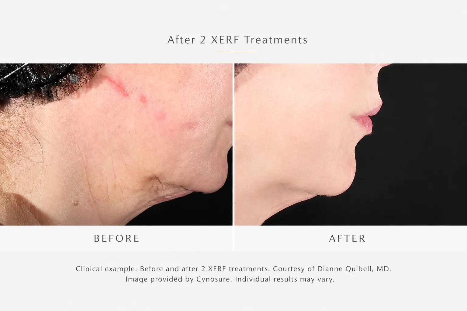 Clinical before and after XERF skin tightening example after two treatments