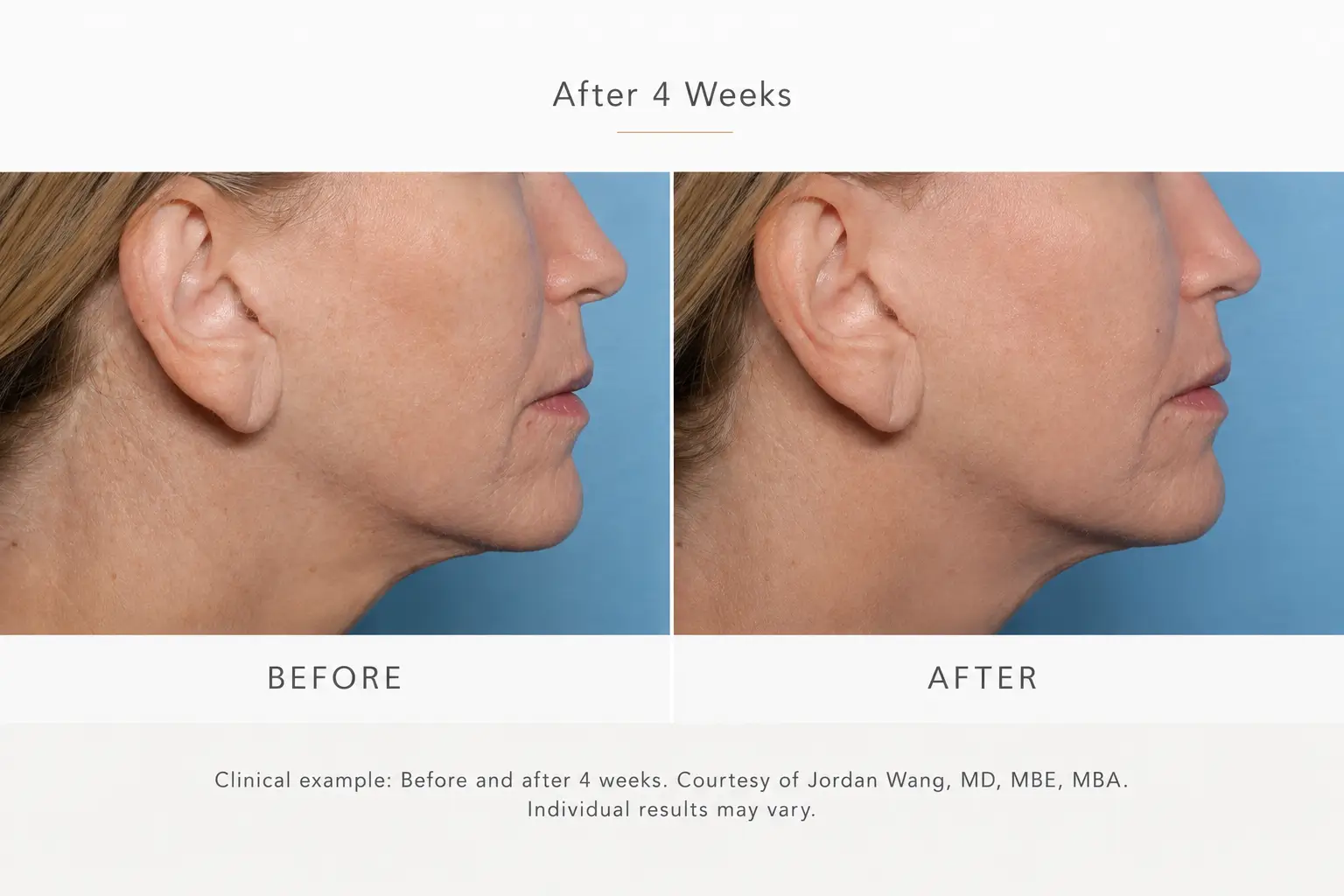 Clinical before and after XERF skin tightening example showing facial profile before treatment and after 4 weeks