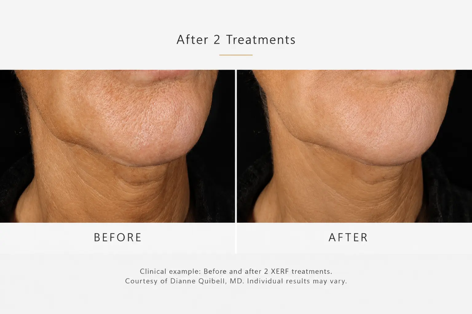 Clinical before and after XERF skin tightening example of the lower face and neck after two treatments